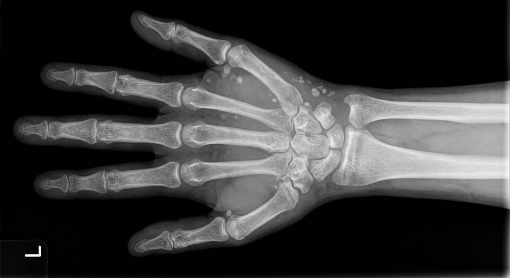 Synthetic extremity X-ray-style image