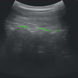 Ultrasound Segmentation